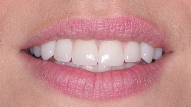 A patient's smile after cosmetic treatment